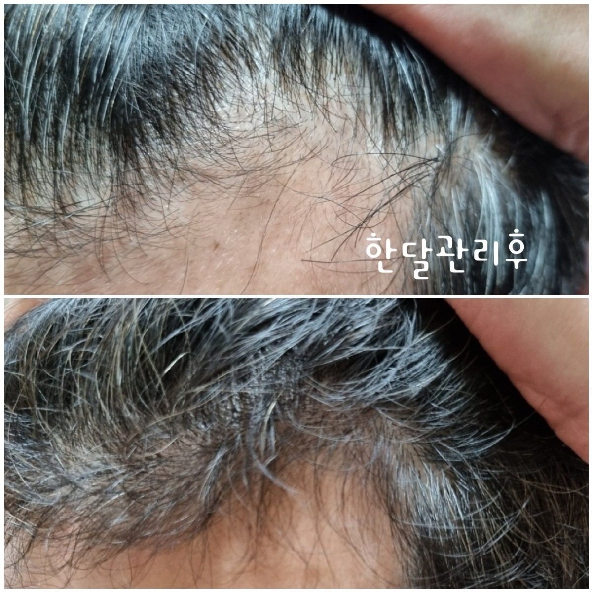 두피도 운동하자!!