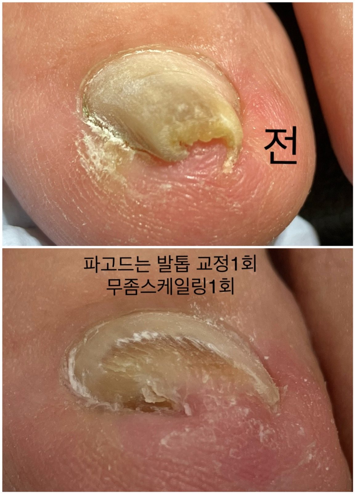 내성발톱,무좀발톱