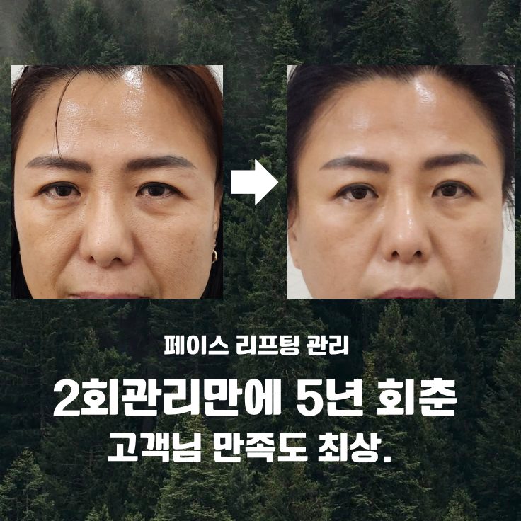 2회 관리만에 5년 젊어진 고객님