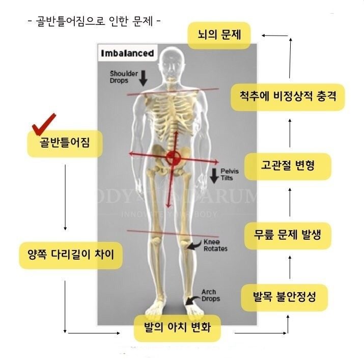 📍골반틀어지면 뇌에도 문제가 생깁니다!📍