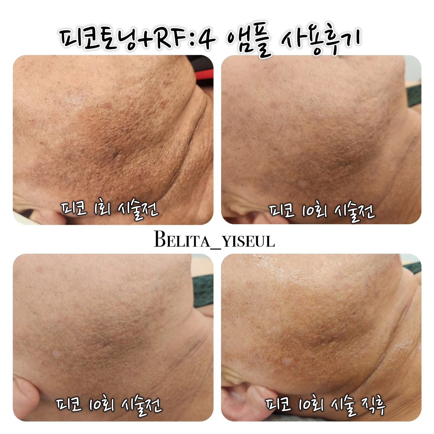 피코토닝+앰플 추가 후 후기