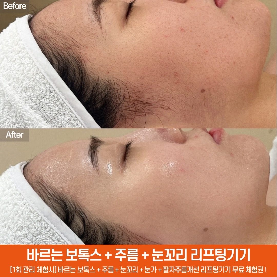 🔴❗️바르는 보톡스 💊 리프팅기기 무료체험권❗️🔴