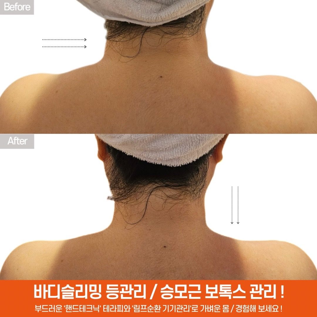 🔴 여름준비 ! 💪🏻 승모근 보톡스관리 이벤트‼️🔴