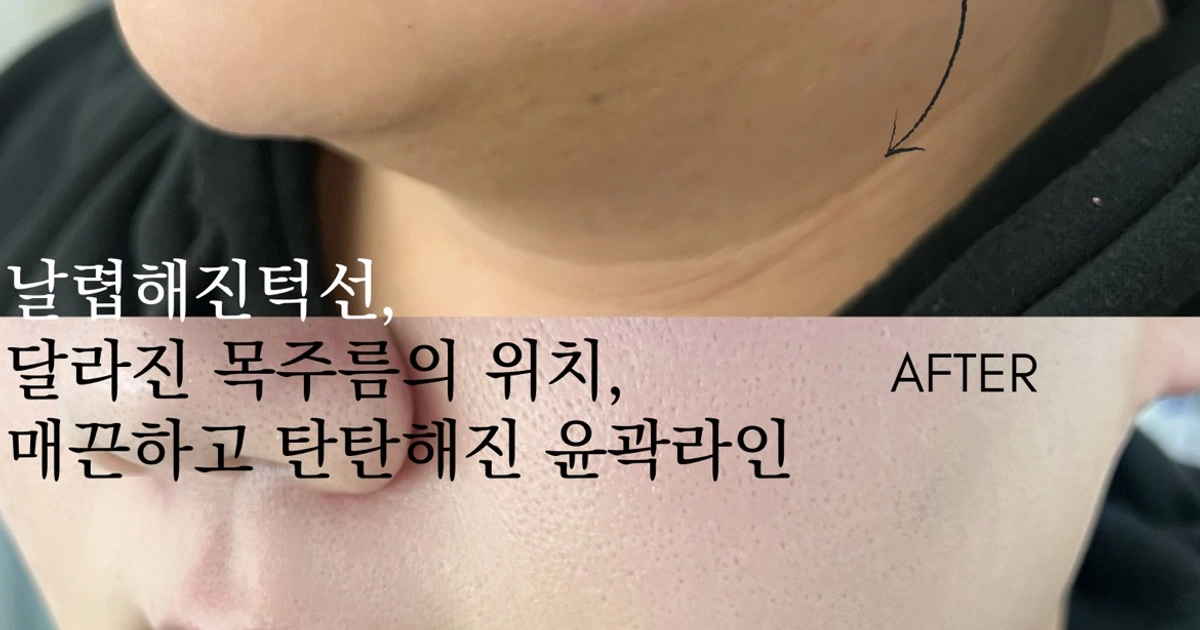 중요한 날에도 ok!! 쳐진볼살,턱살 끌어올려요! | 부산광역시 사하구 하단동 | 속눈썹펌/연장 | 당근 비즈 소식