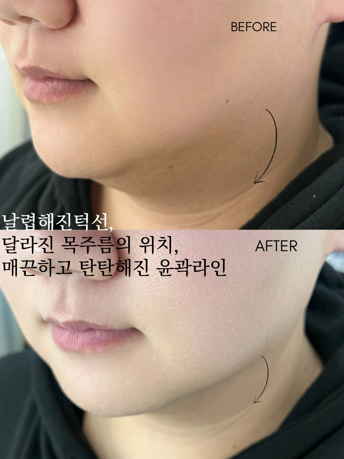 중요한 날에도 ok!! 쳐진볼살,턱살 끌어올려요! | 부산광역시 사하구 하단동 | 속눈썹펌/연장 | 당근 비즈 소식