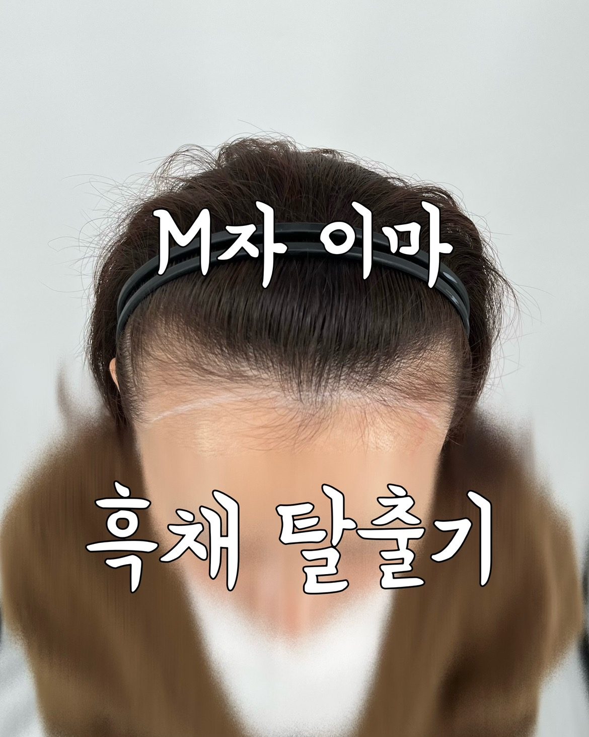 나이들수록 깊어지는 M자 탈모, 흑채탈출기 1회차 후기