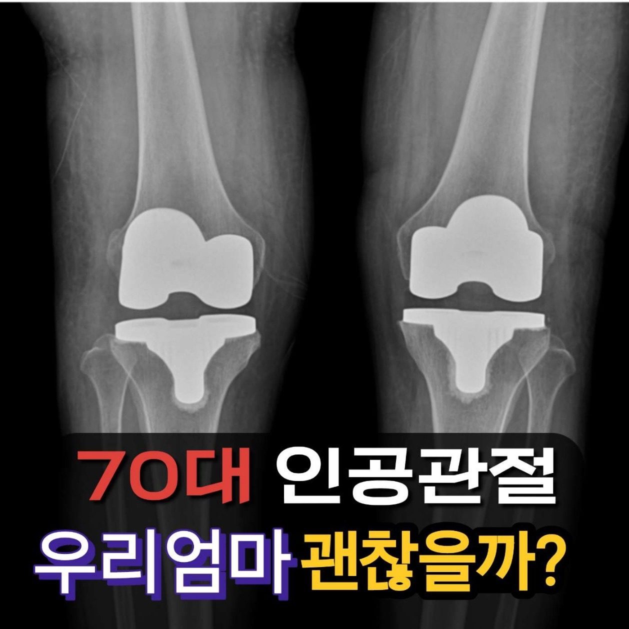 평택 무릎 수술 인공관절 후 빠른회복 70대 어머님 성공사례 