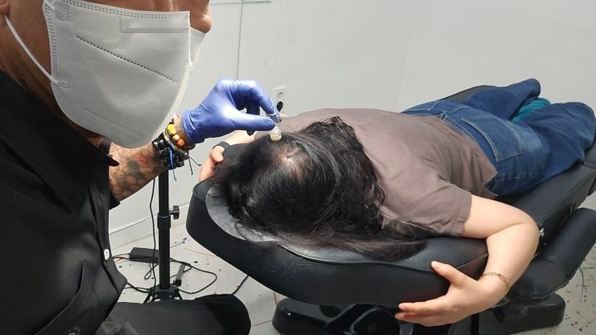 모발재생술 