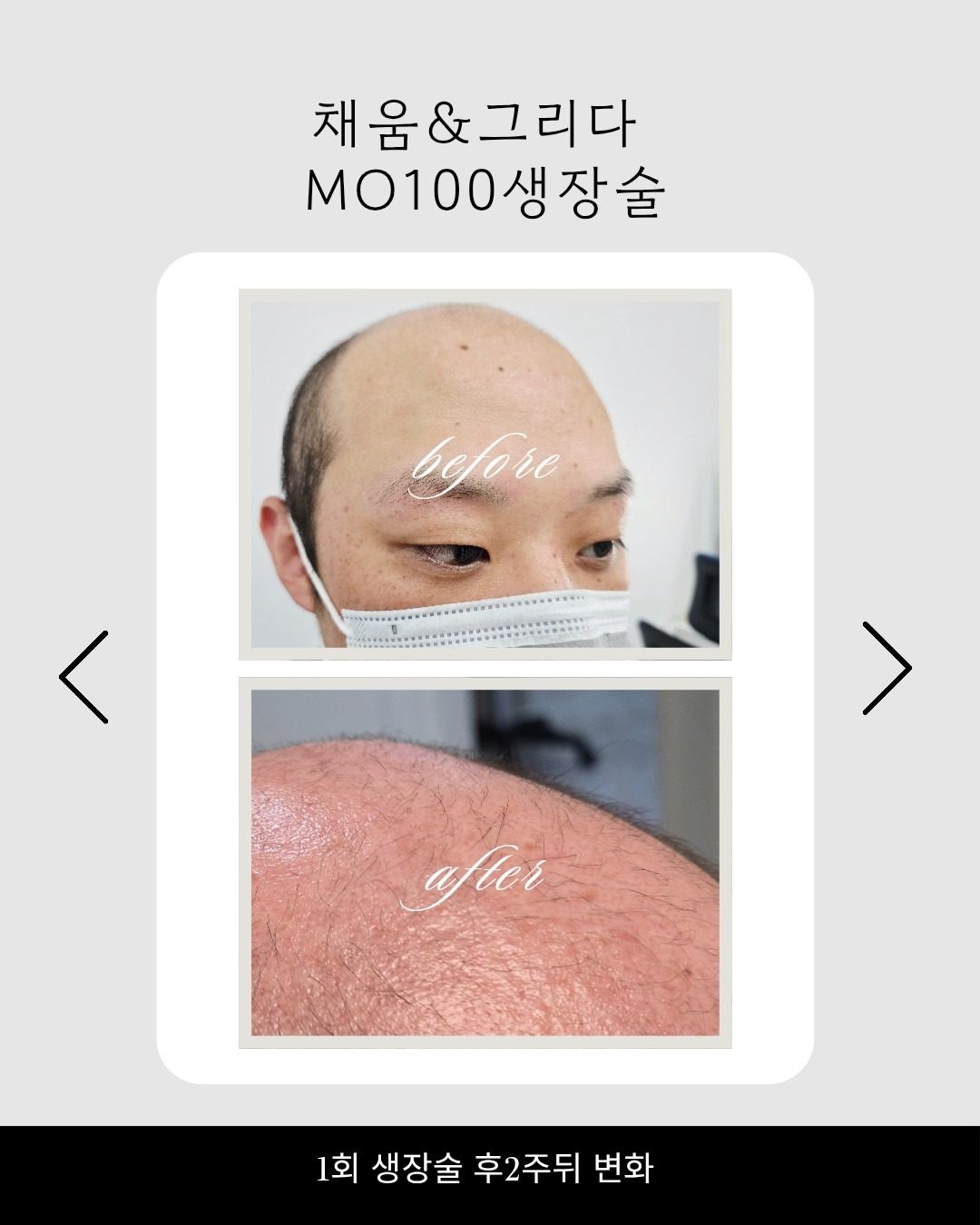 MO100 모발두피생장케어 
