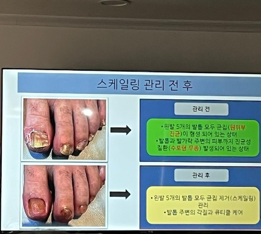 문제성발톱,내성발톱 교정