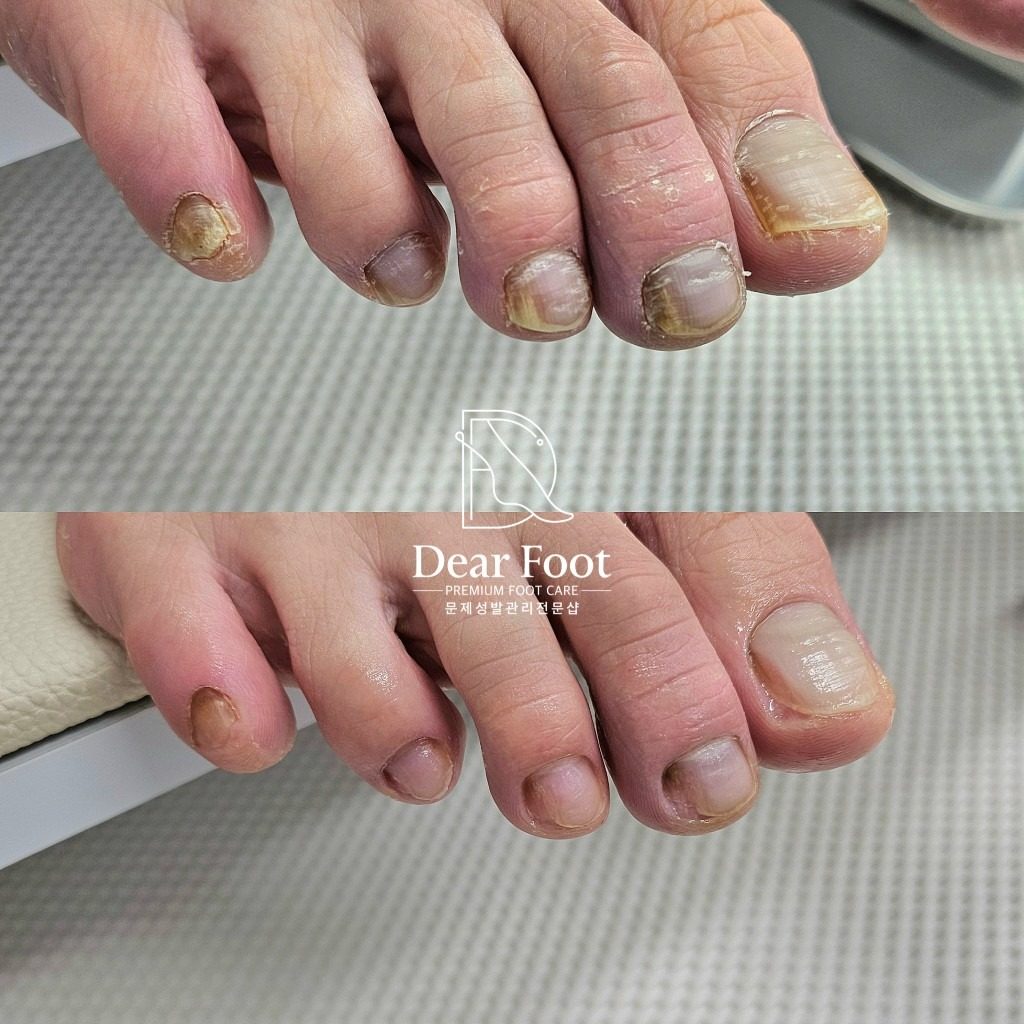 문제성 발톱케어