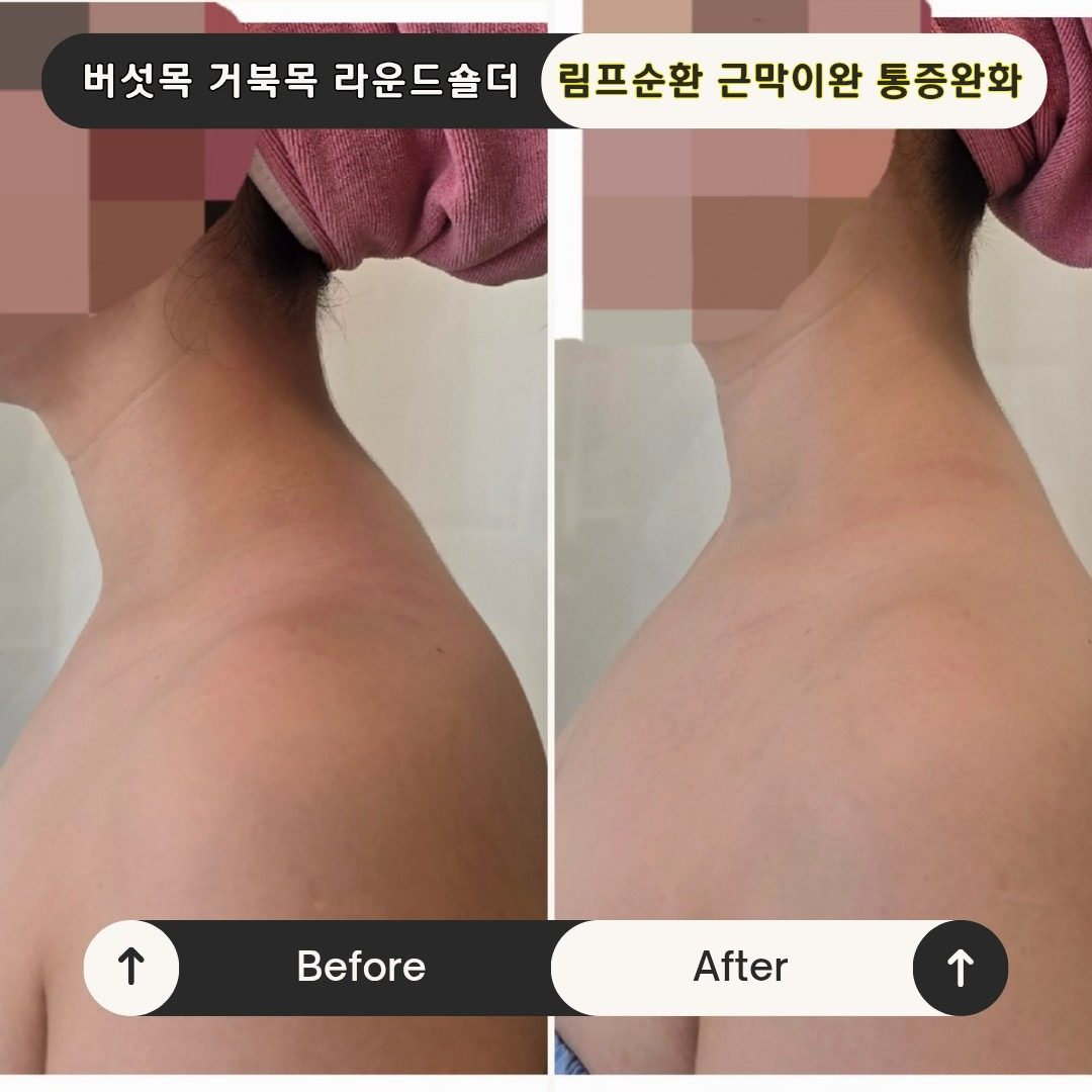 💥어깨가아파서 팔을못들어요! 