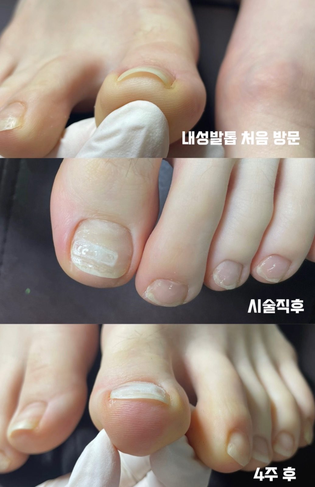 내성발톱 모델 모집합니다〰️👣