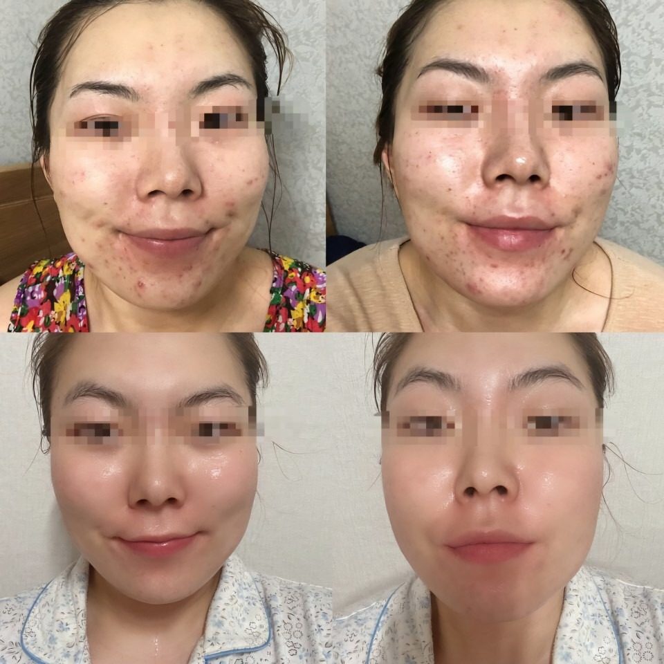 수능끝!! 여드름 끝!!