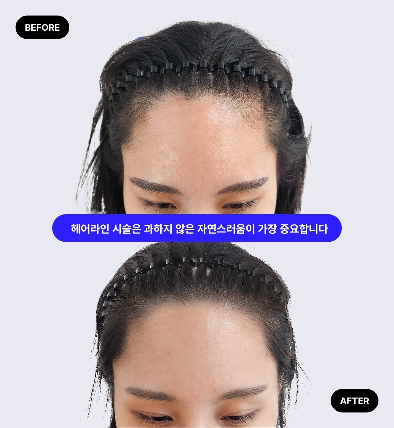 헤어라인 (2회)