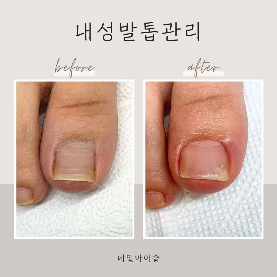 내성발톱교정 6만원💗