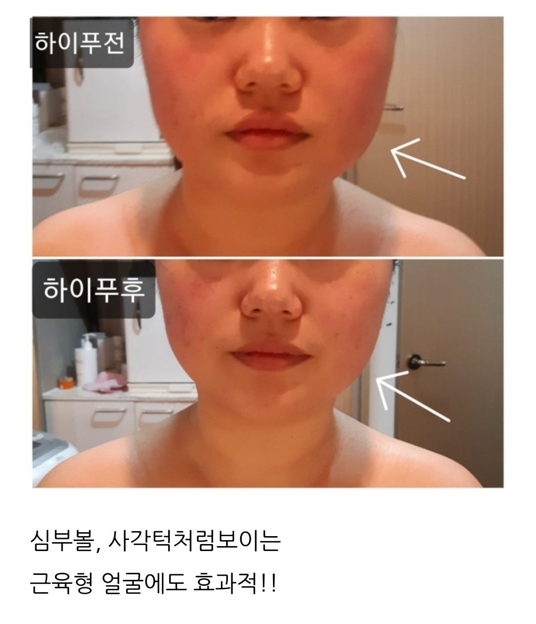 하이푸 리프팅(울세라) 지원하실분 계실까요!^^