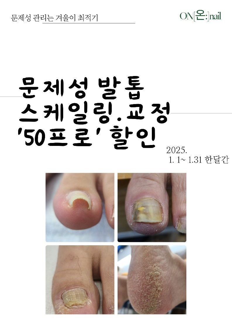 부산대역 4분 문제성발톱 50% 할인!!