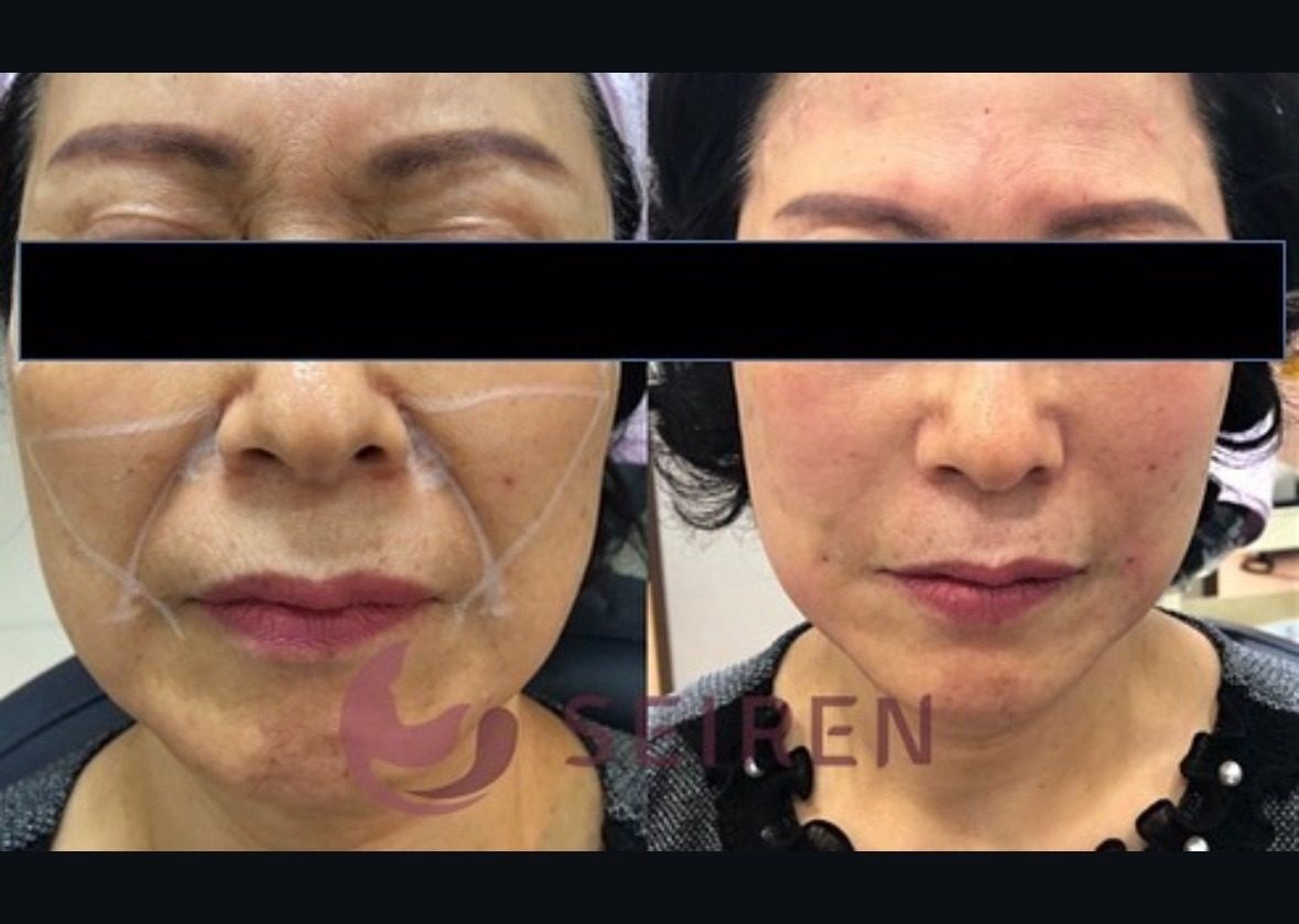 10년 전 피부 되찾고 싶으신가요? 턱라인,심술보,팔자