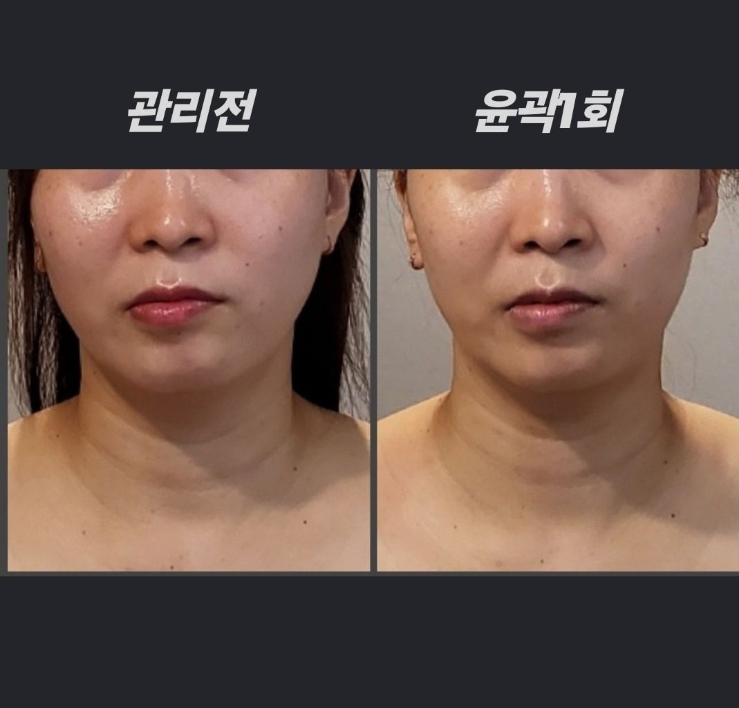 🔸️작고 동글동글한 얼굴🔸️ 당신도 가능해요 