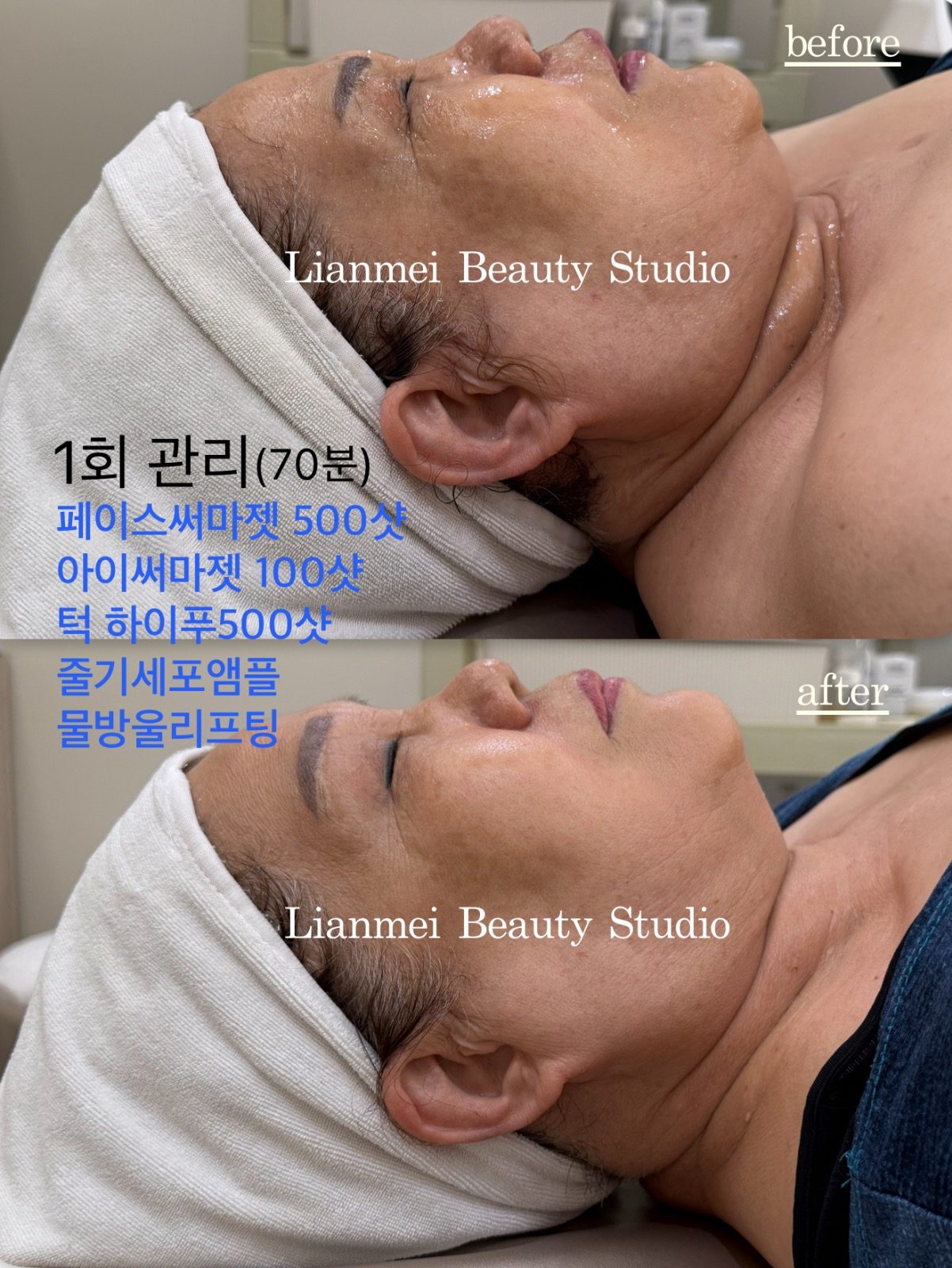 써마젯고주파 첫체험이벤트