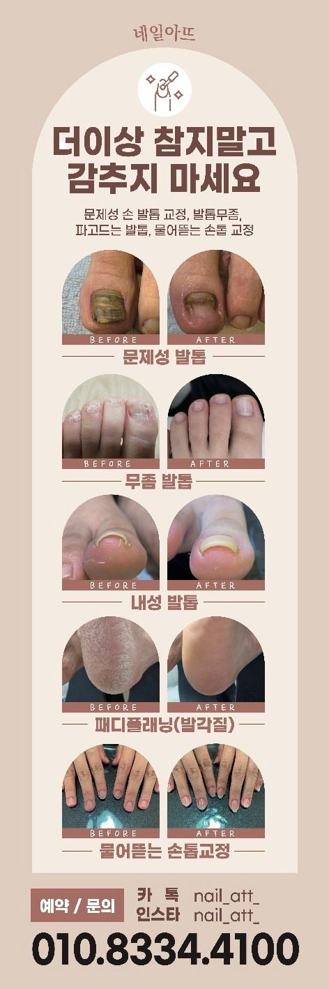 문제성 손발톱 관리 