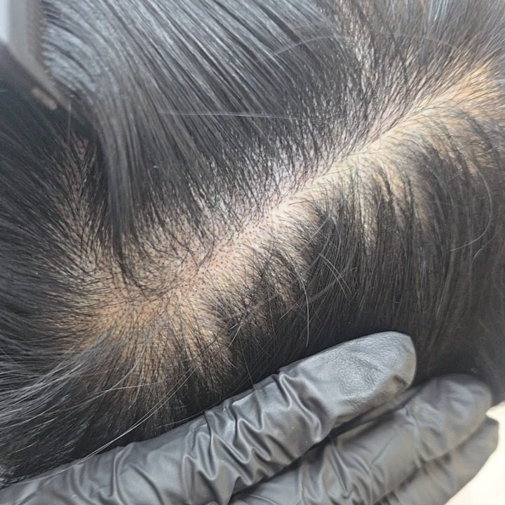 탑 딜라이트-두피문신