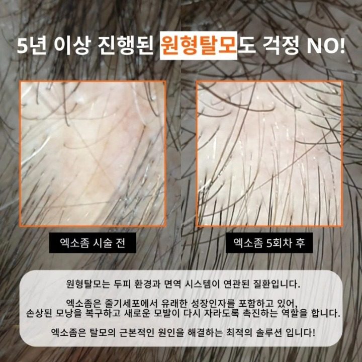 당신의 두피를 채워드려요