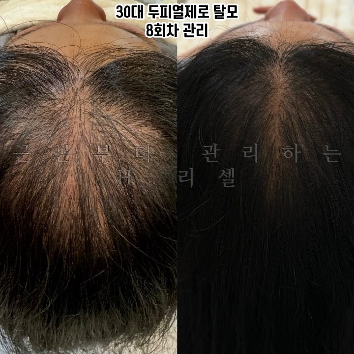 H리셀 탈모두피센터
