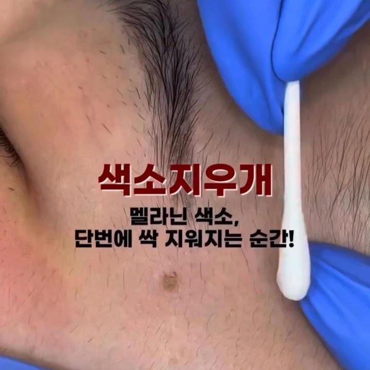 울산 멜라닌케어 전문점