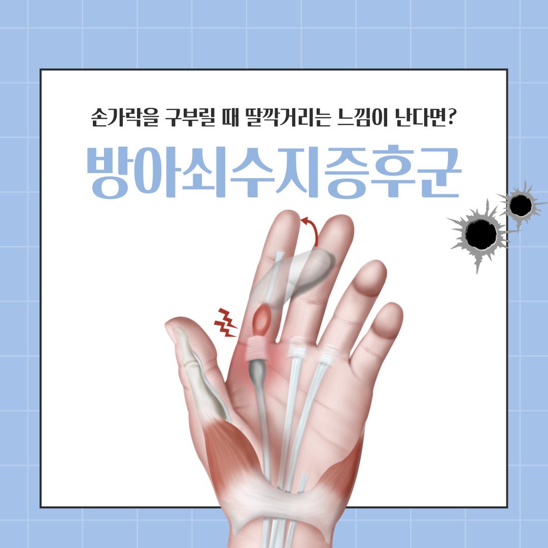 ✅방아쇠수지증후군이란? 🔥 연세바른재활의학과에서 알아볼까요?!