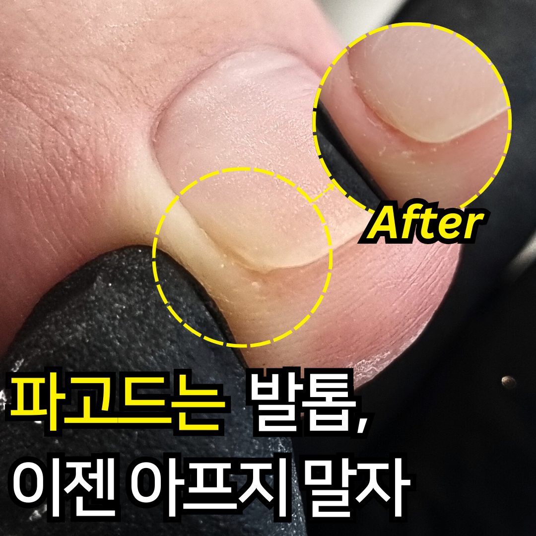 🤒파고드는 발톱, 이젠 아프지 말자🤒