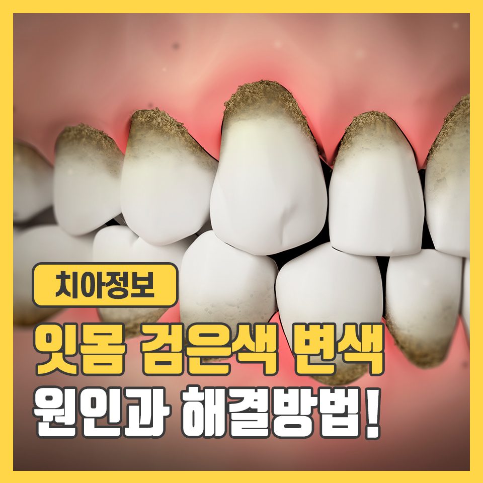 잇몸 검은색 변색 원인 이렇게 해결해요