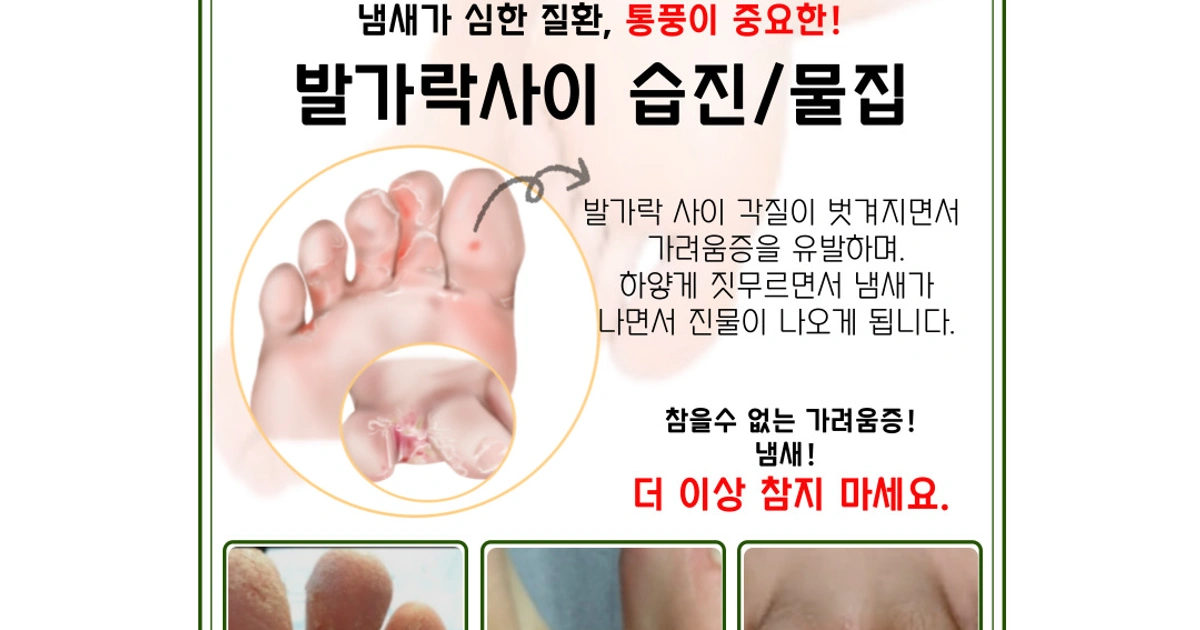 발가락사이 습진/물집/가려움증 | 전라북도 군산시 지곡동 | 네일샵 | 당근 비즈 소식