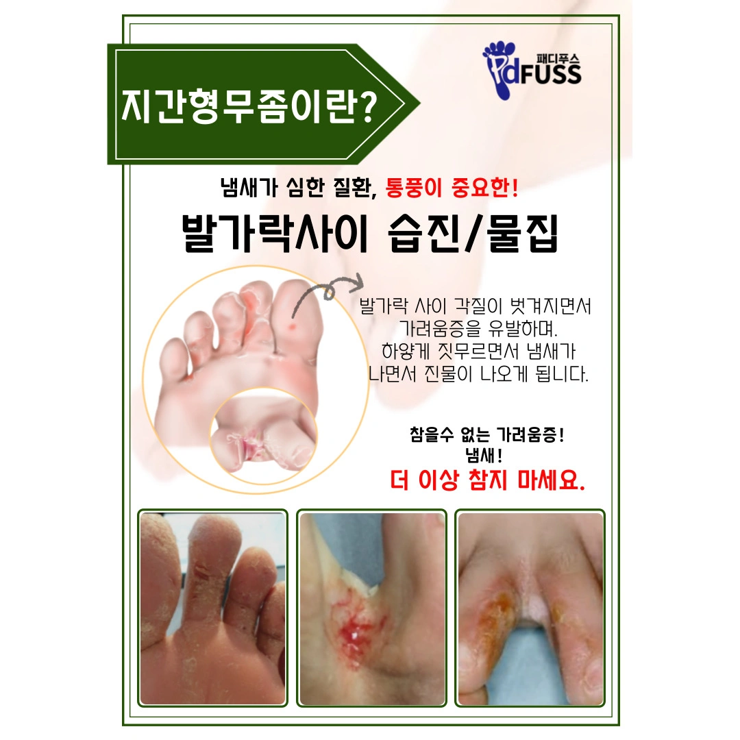 발가락사이 습진/물집/가려움증 | 전라북도 군산시 지곡동 | 네일샵 | 당근 비즈 소식