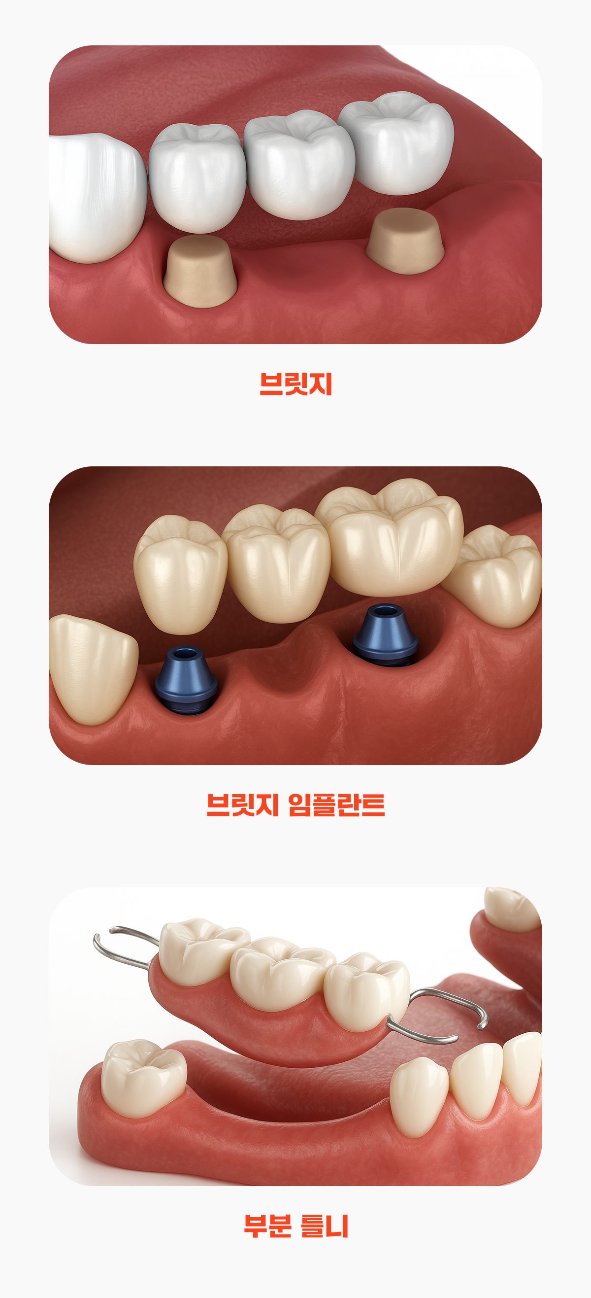 부분틀니 vs 브릿지 vs 브릿지임플란트 비교 분석해 