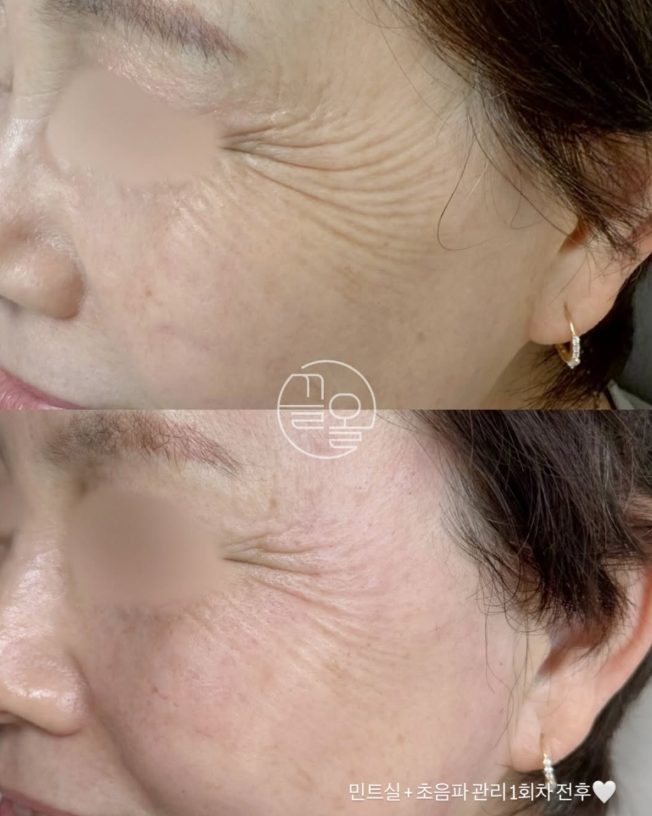 갑자기 눈가주름이 심해졌다면..?