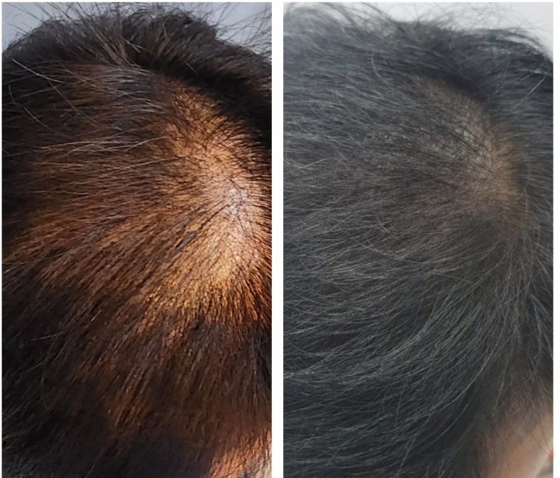 두피 SMP(Scalp Micropigmentation)의 장점과 시술의 필요성