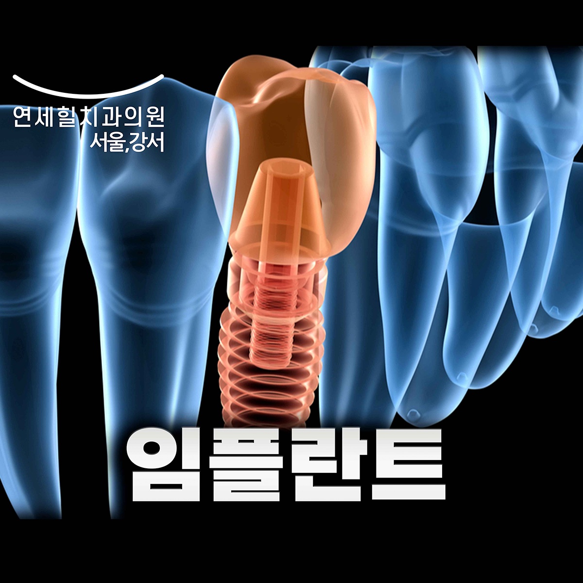 임플란트 가격 꼼꼼히 비교해보세요