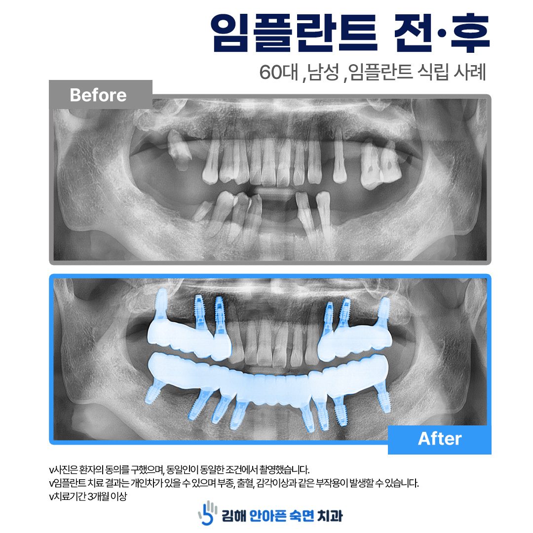 김해 안아픈숙면치과 임플란트 전후