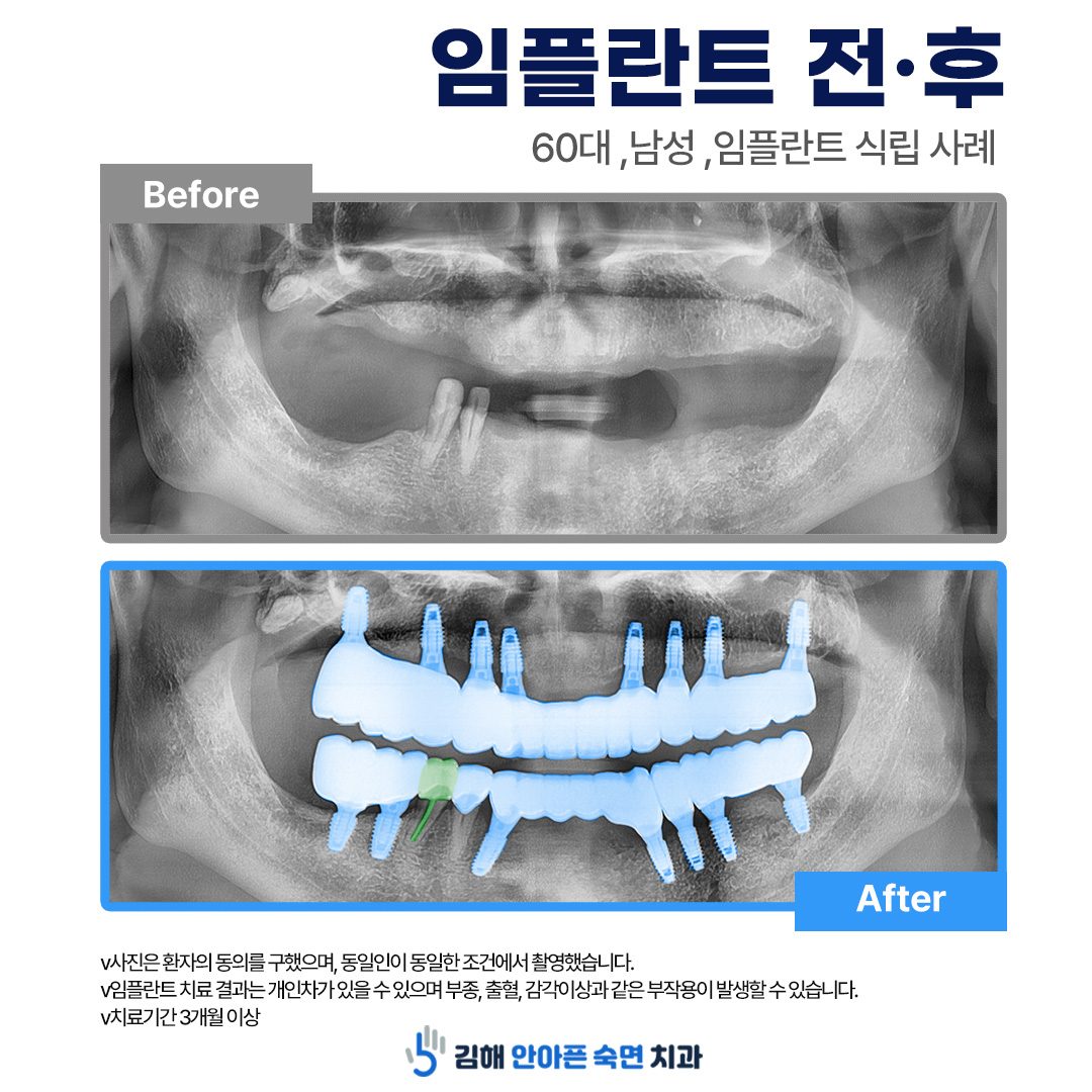 김해 안아픈숙면치과 임플란트 전후