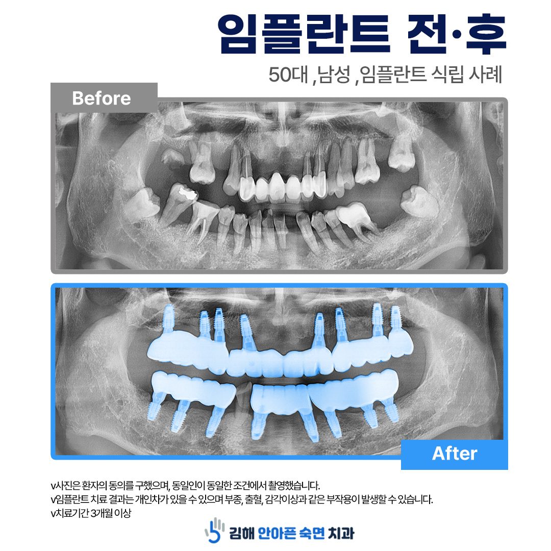 김해 안아픈숙면치과 임플란트 전후