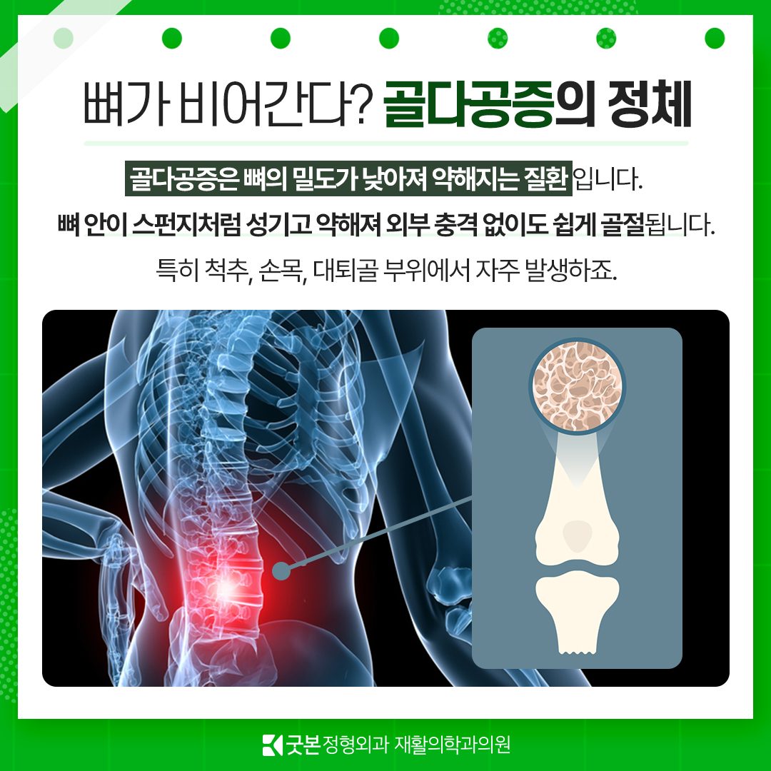 🦴골다공증, 뼈가 비어간다는 신호입니다