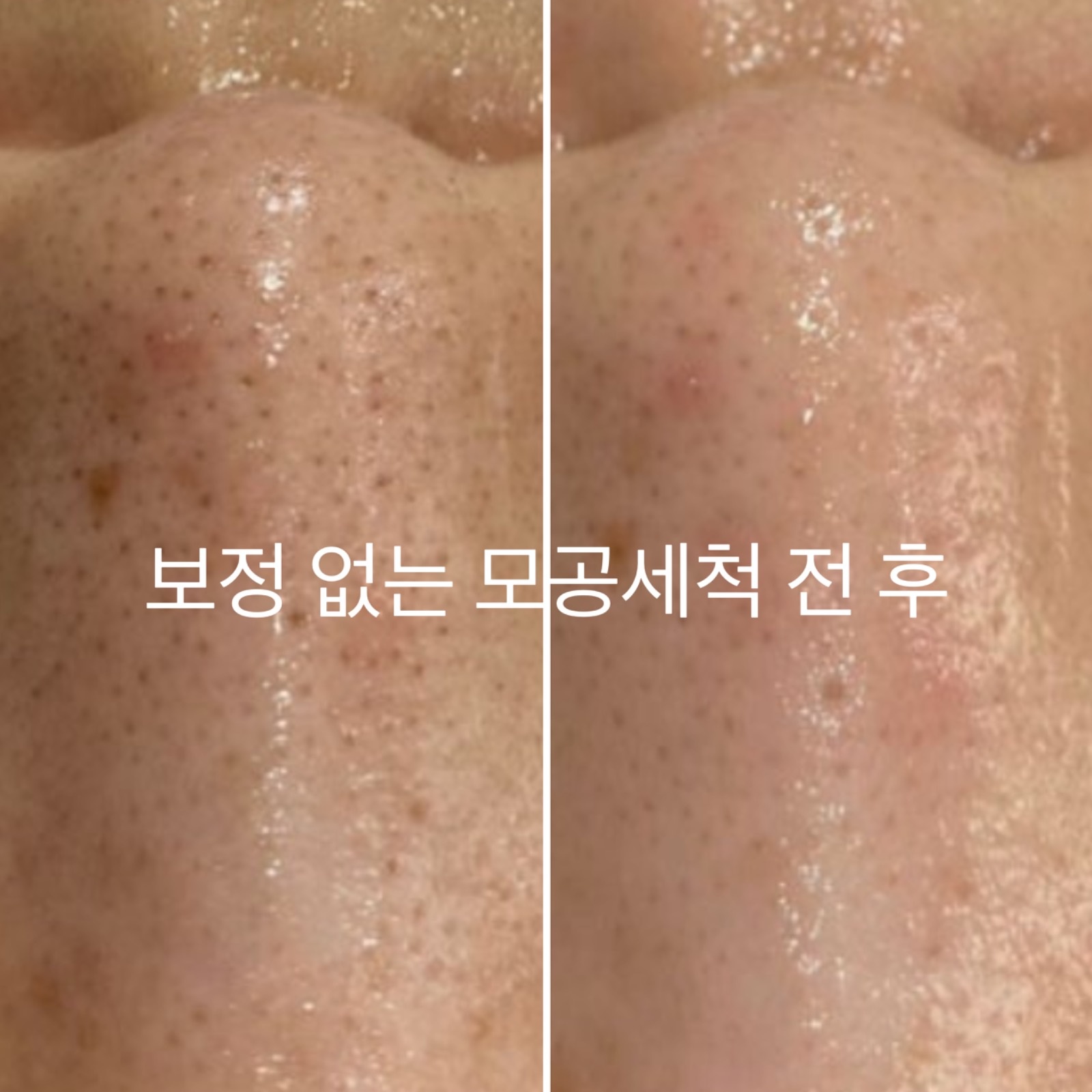 퓨어모공세척테라피 picture 6