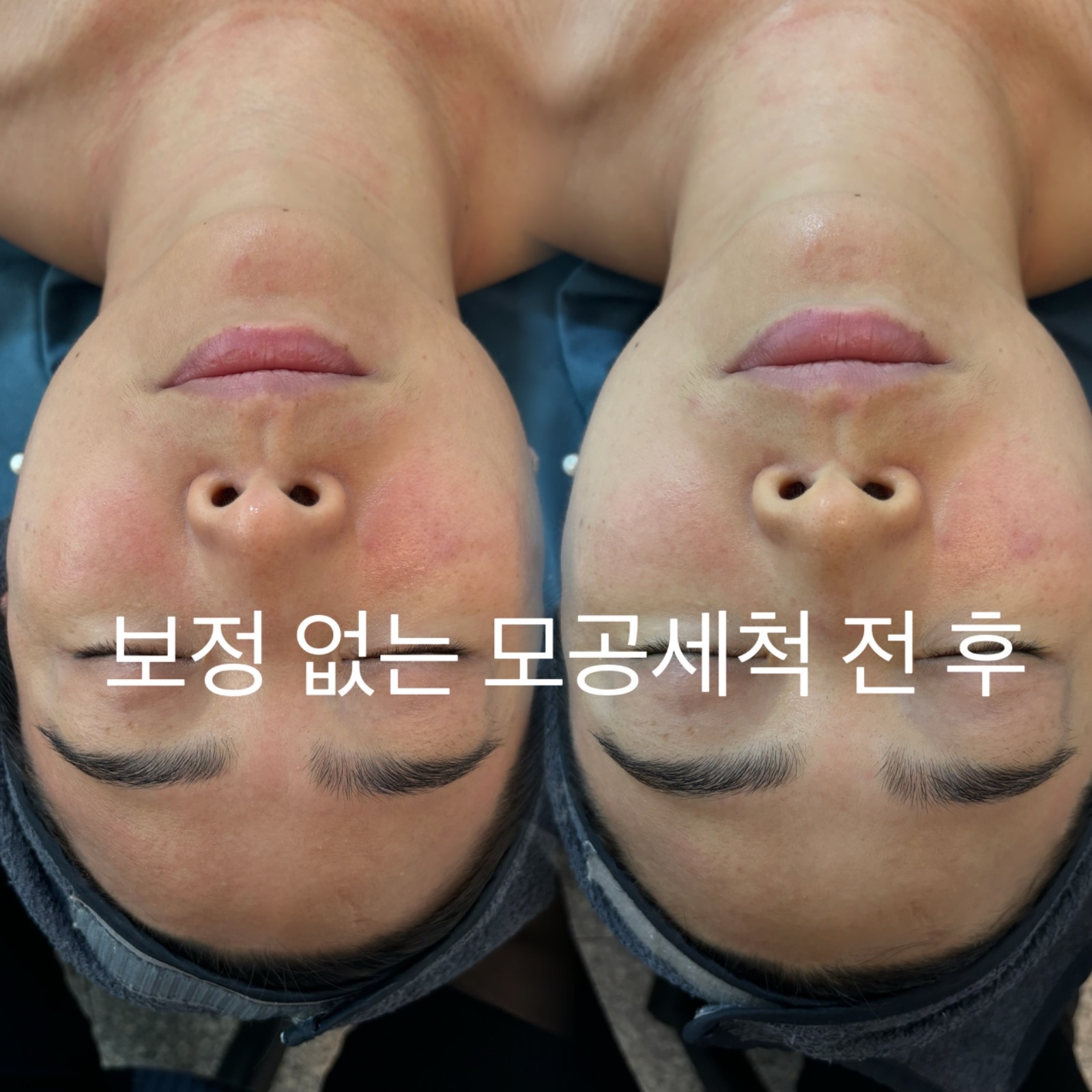 퓨어모공세척테라피 picture 3