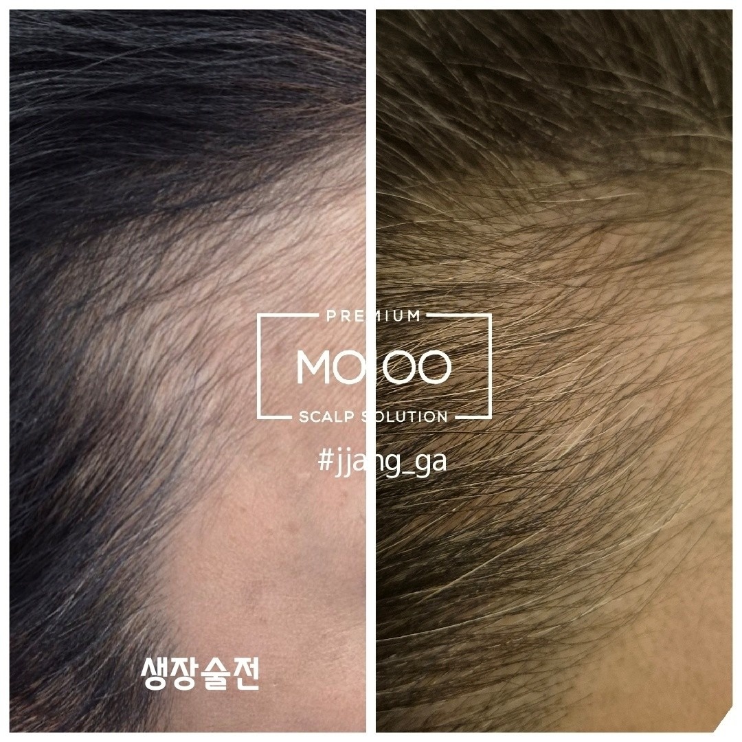 탈모관리전문점 MO100인증점 picture 2