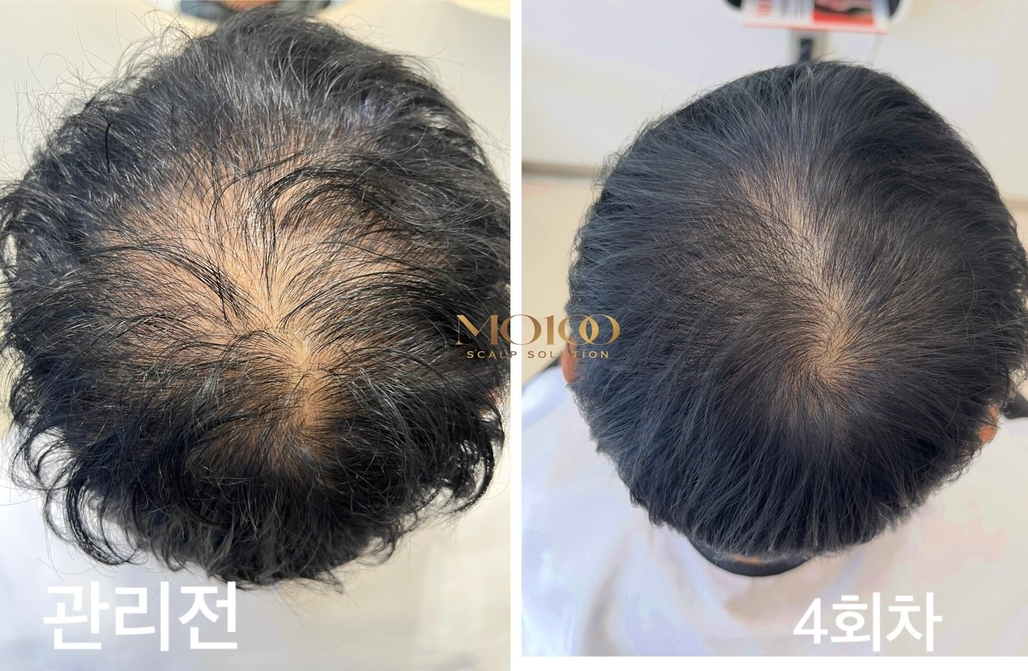 탈모관리전문점 MO100인증점 picture 0