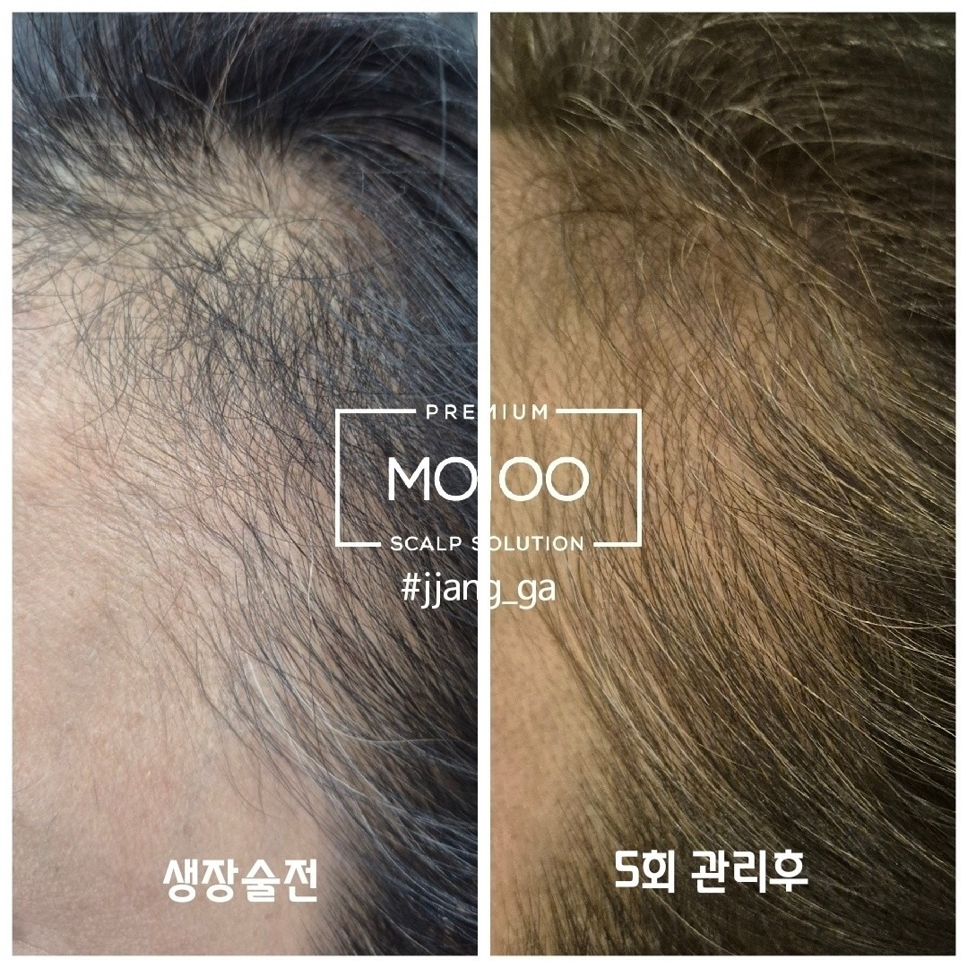 탈모관리전문점 MO100인증점 picture 3
