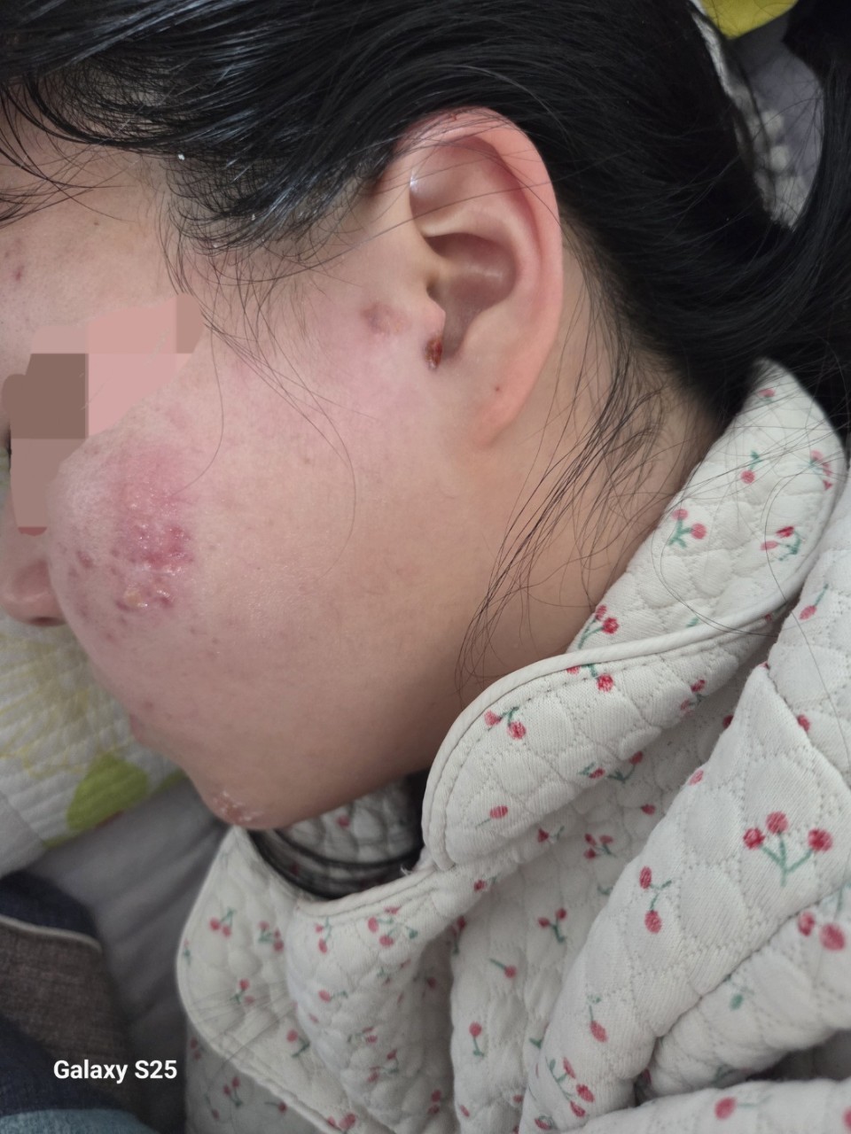 대상포진 5일만에 다 나은 여성