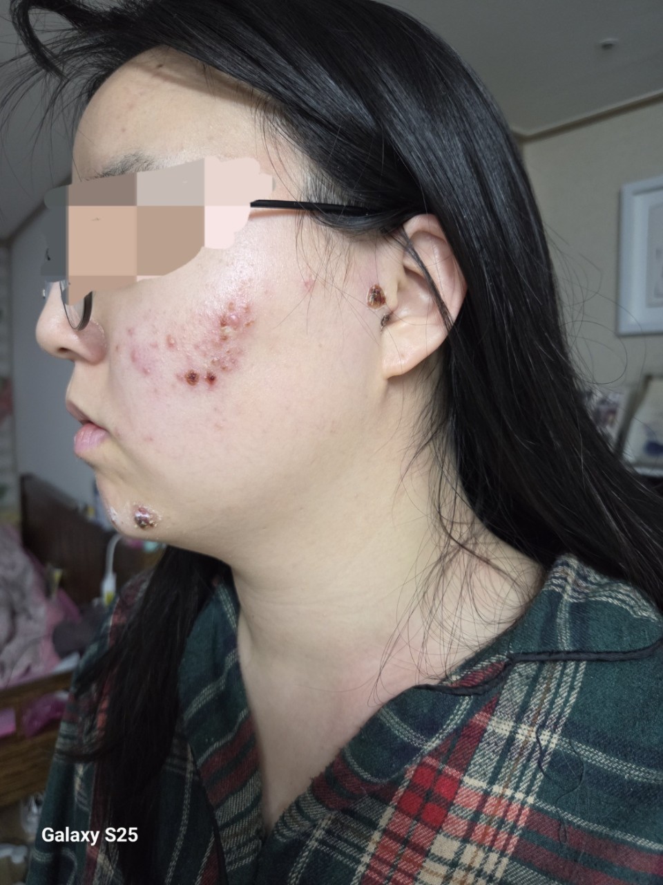 대상포진 5일만에 다 나은 여성